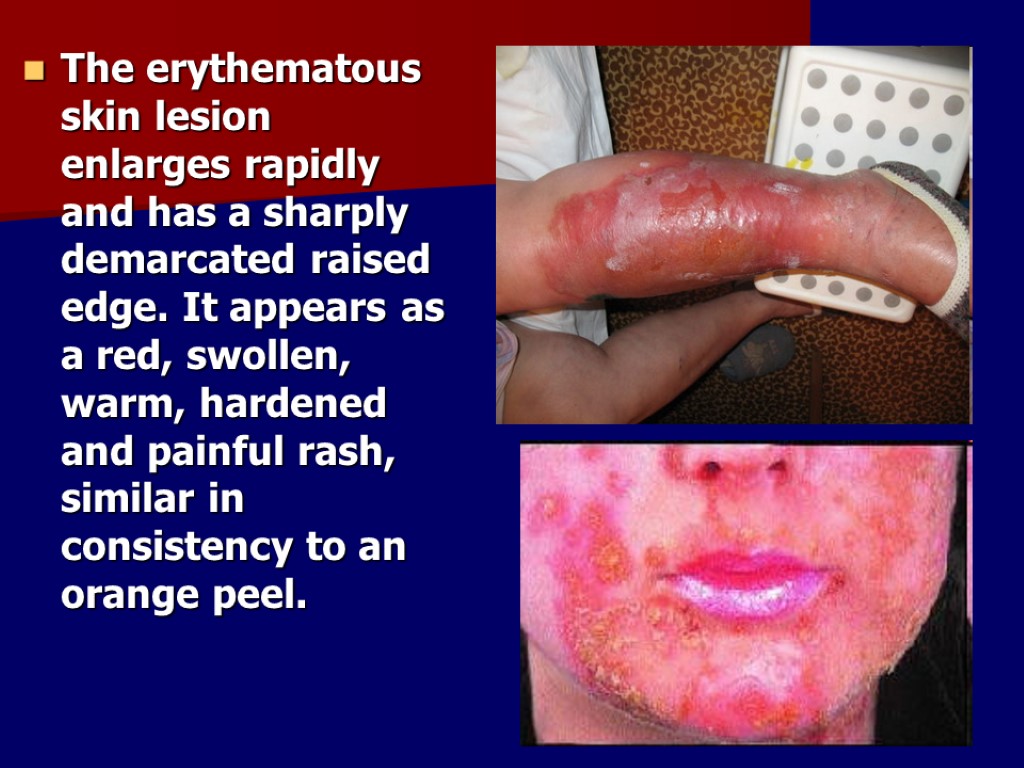 The erythematous skin lesion enlarges rapidly and has a sharply demarcated raised edge. It